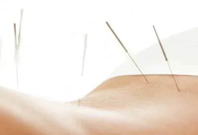 Patient receiving Medical Acupuncture